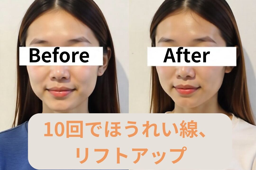 美容鍼10回でほうれい線、リフトアップ