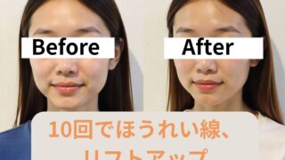 美容鍼10回でほうれい線、リフトアップ