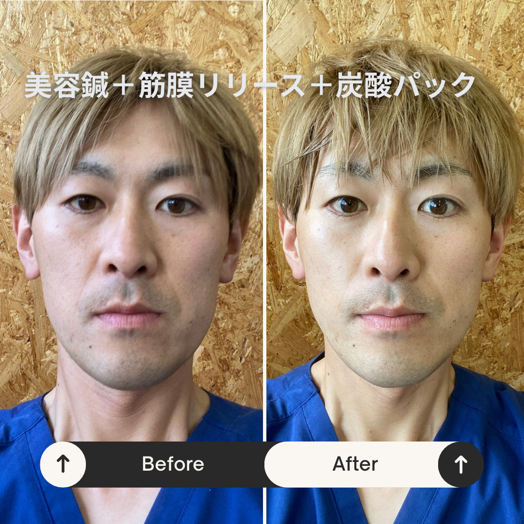 美容鍼後のビフォーアフター