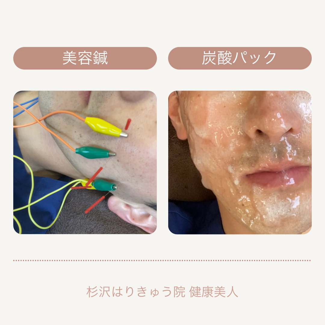 美容鍼と炭酸パックのイメージです。