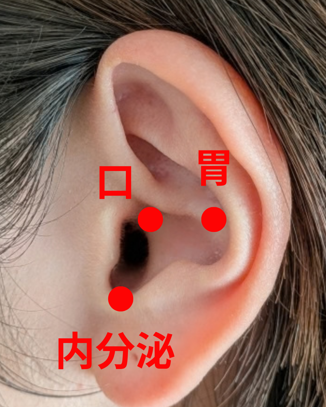 脂肪太りの場合（痰湿、滑脈）
